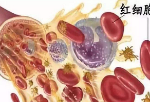 缺鐵性心臟病最常見(jiàn)病因是什么