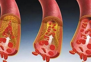 什么是冠動(dòng)脈粥樣硬化心臟病