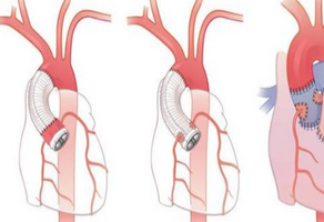 小孩先天性心臟病有什么癥狀