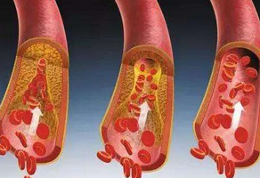 心臟搭橋和支架有什么區(qū)別