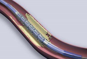 心臟支架手術(shù)后注意事項(xiàng)和后遺癥都有哪些