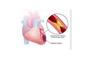 心肌梗死的護(hù)理有哪些？