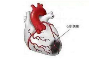 心肌缺血的原因與危害