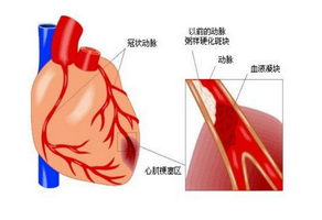 心肌缺血的癥狀有哪些？又該如何治療？