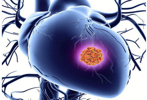 缺血性心臟病的治療方式都有哪些