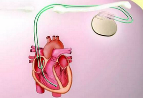 安裝心臟起搏器的各種注意事項有哪些？
