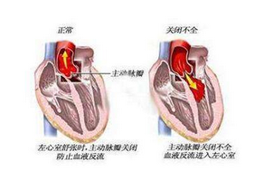 二尖瓣關閉不全的日常護理