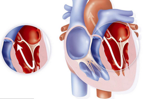 二尖瓣關閉不全的癥狀有哪些？