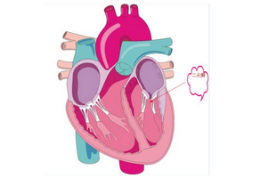 二尖瓣狹窄的危害性