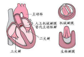 二尖瓣狹窄怎樣預(yù)防