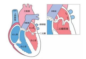 二尖瓣狹窄癥狀有哪些
