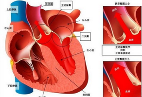風(fēng)濕性心臟病是什么？