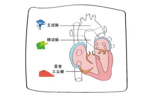 三尖瓣狹窄該如何預(yù)防