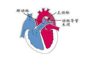 三尖瓣狹窄如何預(yù)防保健？