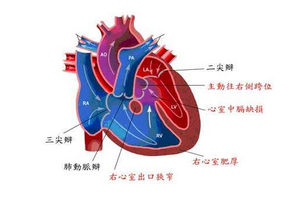 心肌梗塞的診斷標(biāo)準(zhǔn)是什么？
