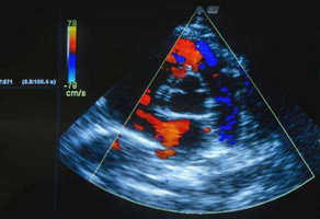 心臟彩超是什么