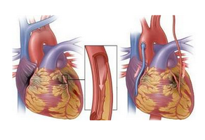 心臟搭橋手術(shù)是什么
