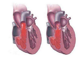 主動(dòng)脈瓣狹窄有哪些典型的癥狀表現(xiàn)？
