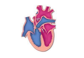 主動(dòng)脈瓣狹窄怎么預(yù)防