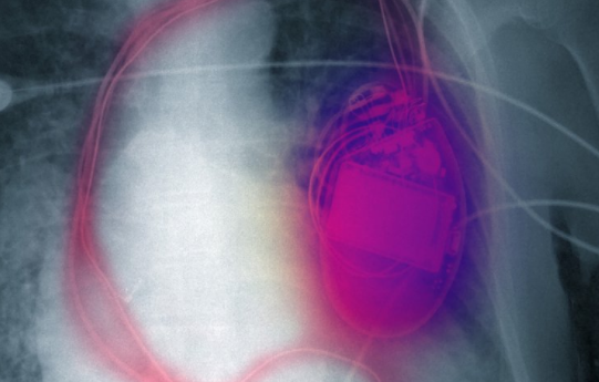 心律失常有效的治療方法是什么