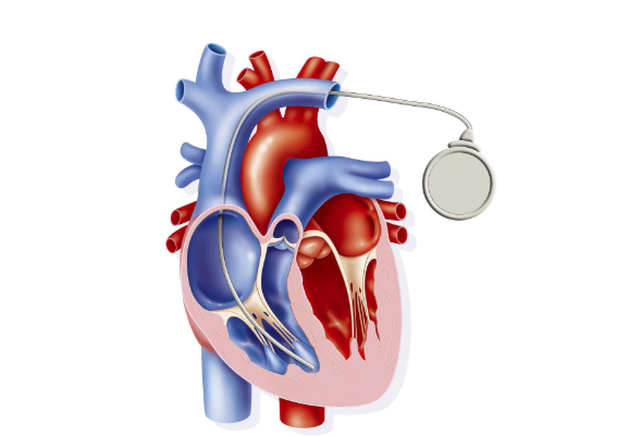 急性心肌炎可能會導致猝