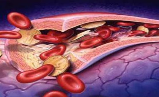 老人出現(xiàn)動脈硬化到底怎么辦才好