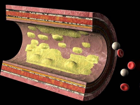 動脈硬化斑會噴發(fā)嗎