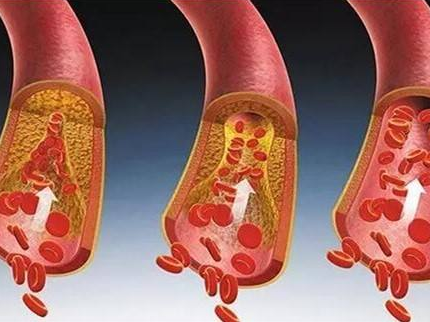 動脈硬化的易患人群有哪些?
