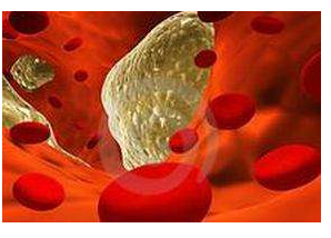 動(dòng)脈硬化的早期危險(xiǎn)信號(hào)