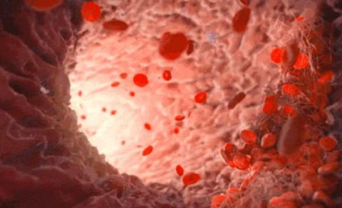 動(dòng)脈硬化給患者帶來的危害