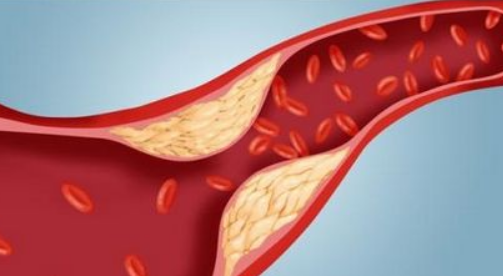 動(dòng)脈硬化恢復(fù)治療方法都是什么