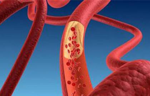 動(dòng)脈硬化性閉塞癥知識(shí)分享