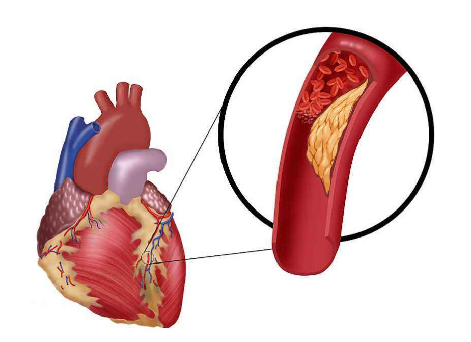 動(dòng)脈硬化須知的先期癥狀