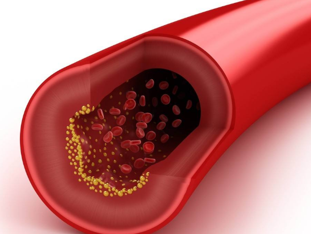 動(dòng)脈硬化藥物治療有效嗎