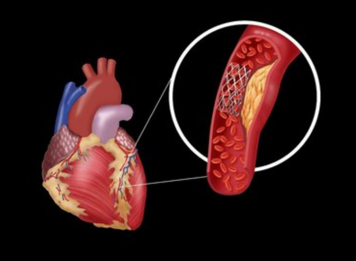 動(dòng)脈硬化易引起哪些并發(fā)癥呢