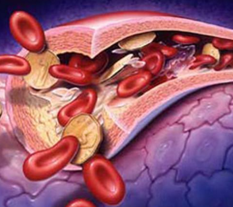 動(dòng)脈粥樣硬化的診斷和手術(shù)措施