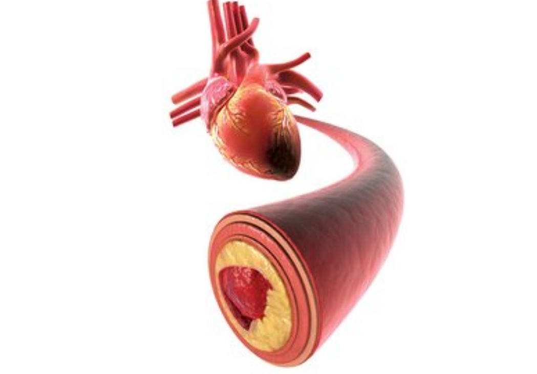 動(dòng)脈粥樣硬化有哪些危險(xiǎn)區(qū)呢