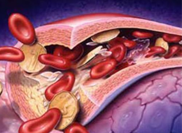 關(guān)于如何防止動(dòng)脈粥樣硬化斑塊的破裂