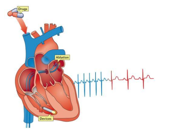 心律失常是種特殊的心臟病