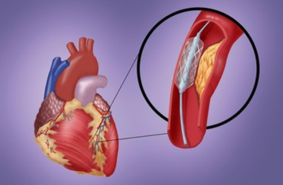 哪些疾病引起了動(dòng)脈粥樣硬化你了解嗎