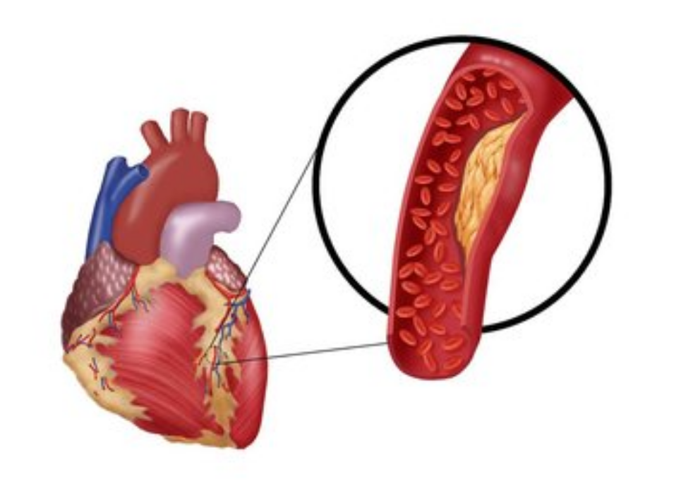 引發(fā)動(dòng)脈硬化主要是生活習(xí)慣不規(guī)律