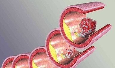 糖尿病人易引發(fā)動(dòng)脈硬化