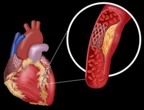 腿部動(dòng)脈硬化是怎么回事