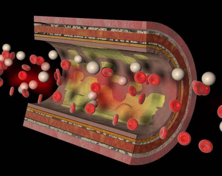 誘發(fā)動脈硬化的因素有哪