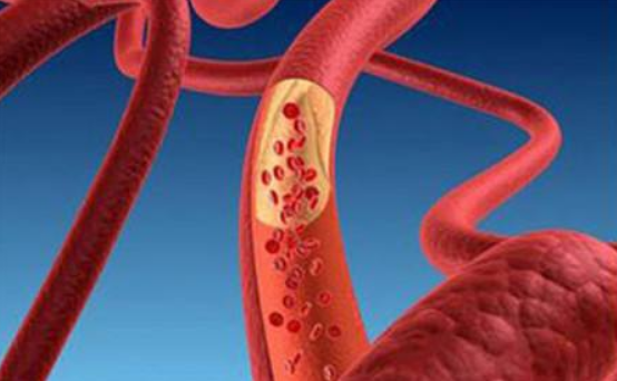 主動(dòng)脈硬化的治療方法有哪些
