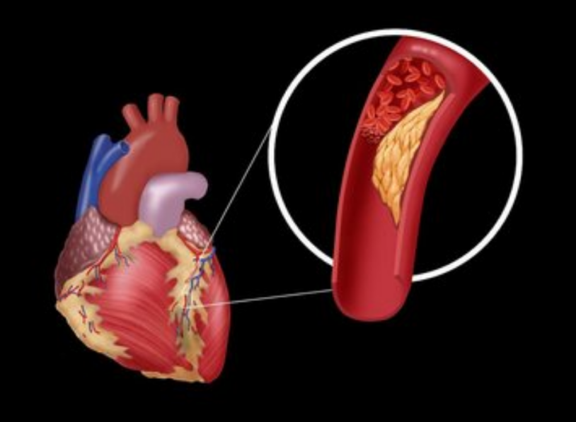 主動(dòng)脈硬化的治療手段都有哪些