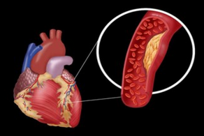 冠心病的15個典型癥狀介紹