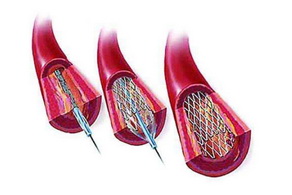 胸痛應(yīng)提防冠心病